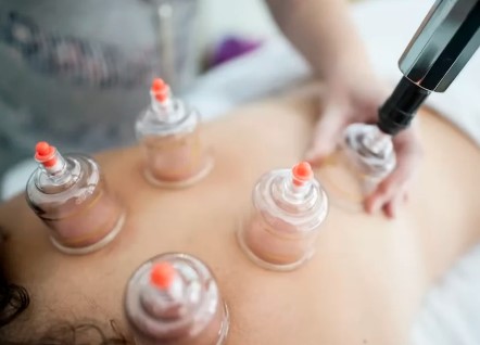 Séance de Cupping Therapy dans le 6ème arrondissement de Lyon